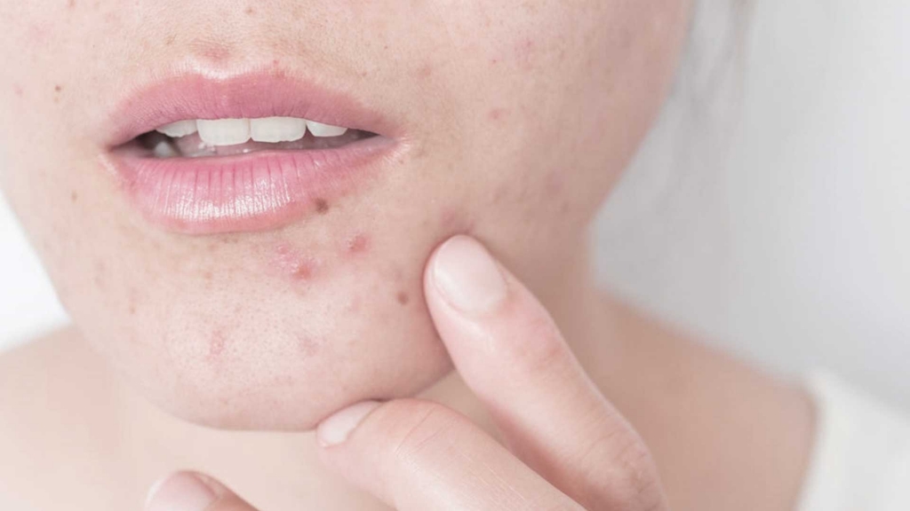 cure for acne