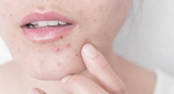 I have Acne-Prone Skin, what should I do?